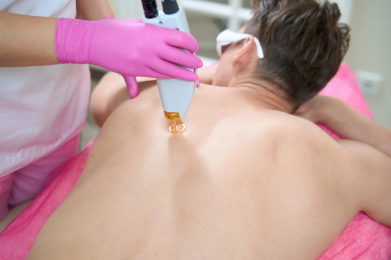 back laser hair removal