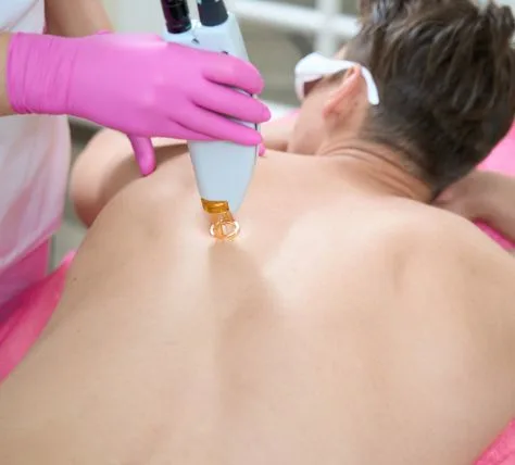 back laser hair removal
